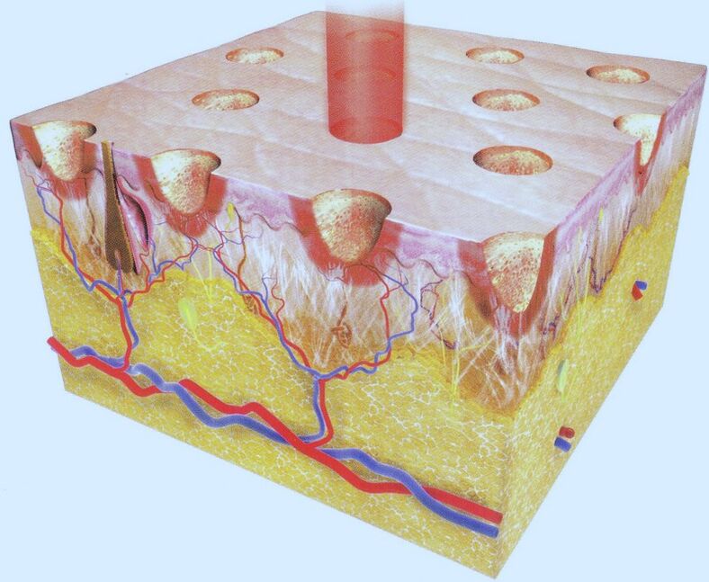 fraktionierte Laserthermolyse